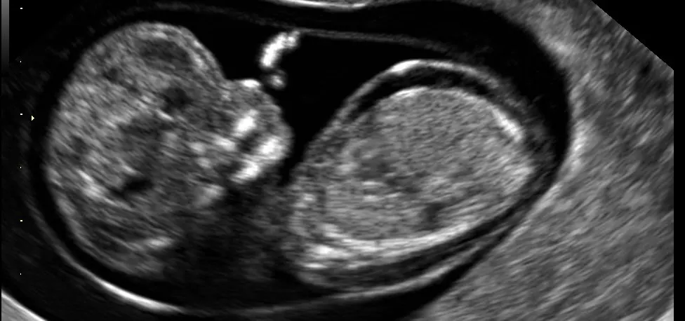 В брюшной полости ребенка УЗИ показало наличие зародыша