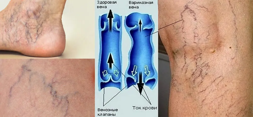 Варикозное расширение вен — кратко