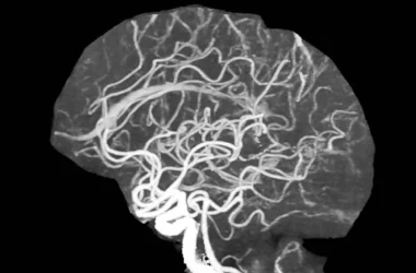 ИИ умеет выявлять сужение мозговых артерий