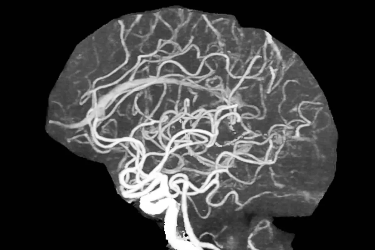 ИИ научили выявлять сужение мозговых артерий